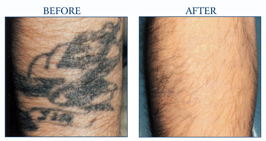 North Houston Laser Tattoo Removal, Houston Tattoo Removal